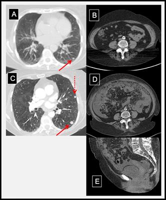 Case Report: Simultaneous Hyperprogression and Fulminant Myocarditis in a Patient With Advanced Melanoma Following Treatment With Immune Checkpoint Inhibitor Therapy
